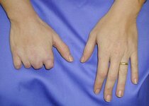 proximal-finger-amputation-multiple.jpg