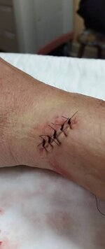 stitches.jpg