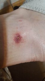 Wolf Spider Bite.jpg