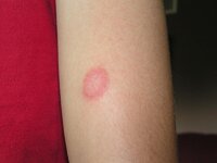 Matt's-Spider-Bite.jpg