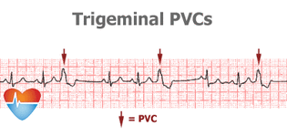 trigeminy_pvc.gif