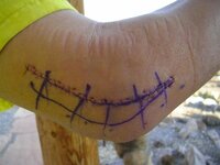elbow stitches.jpg